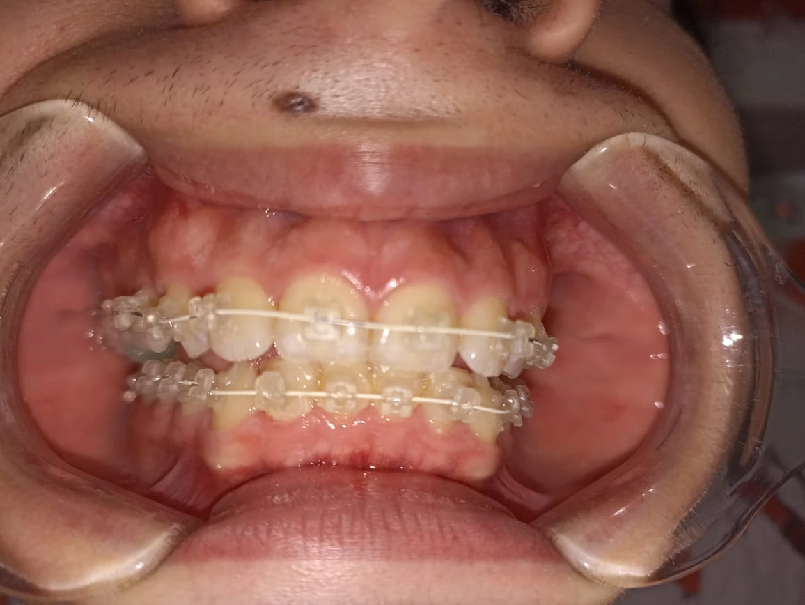 Antes del tratamiento de Miguel